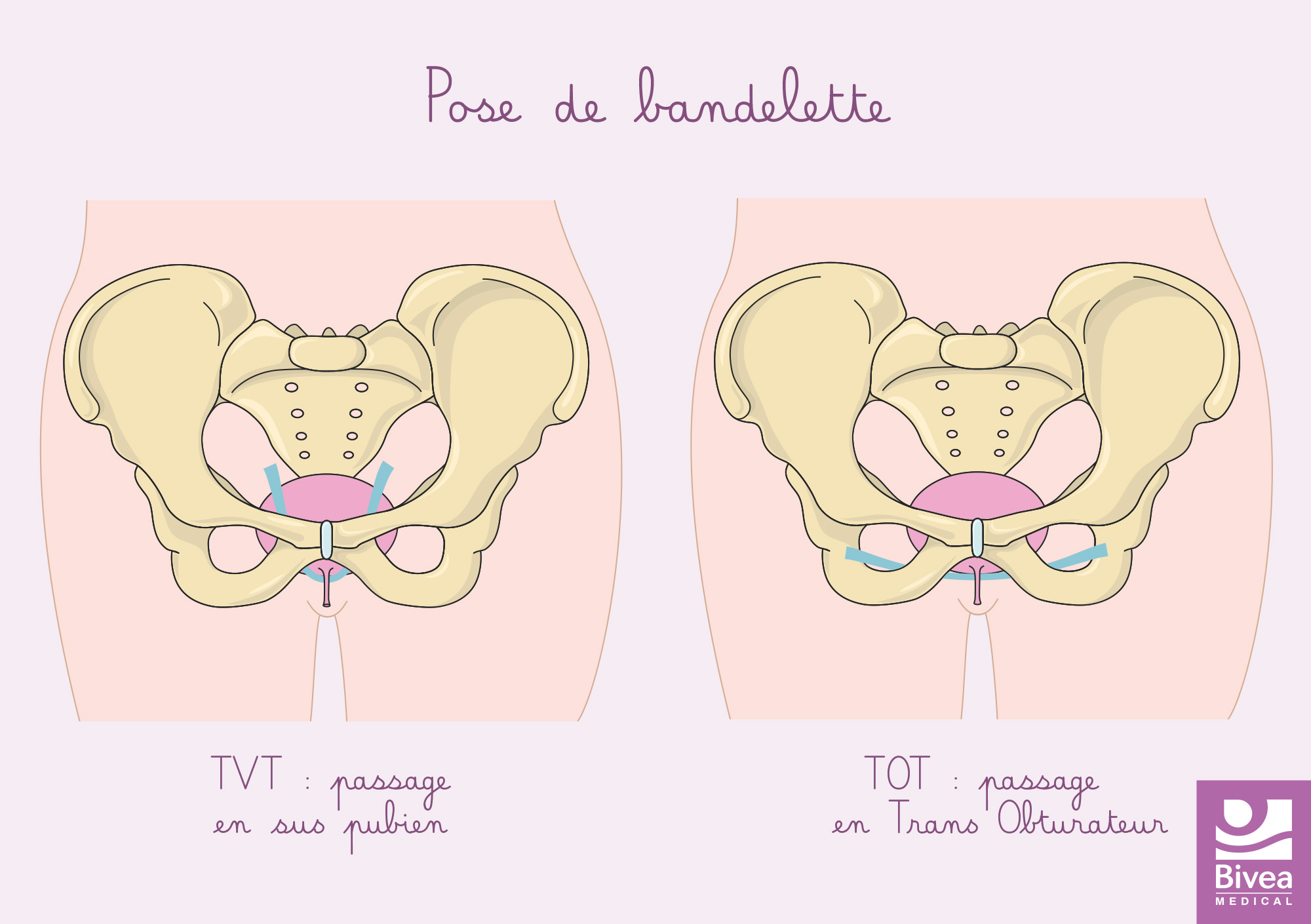 explication de la cystoplexie ou operation pour fuite urinaire, chirurgie TVT