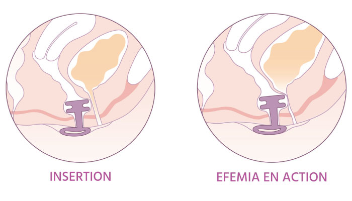 solution incontinence urinaire femme efemia